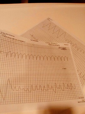My EKG showing an arrithmia chart from when I was in the ER.