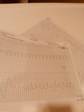 The EKG showing my arrhythma on 04202021