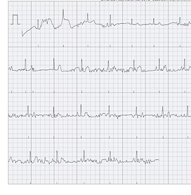 Ekg