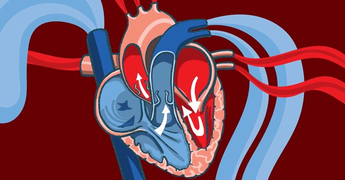 Living With Heart Failure: Reduced Ejection Fraction vs. Preserved Ejection Fraction image