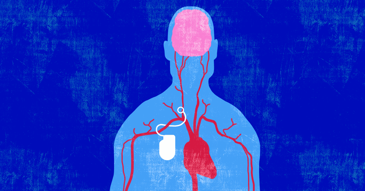 Barostim Therapy for Heart Failure: What You Need to Know image